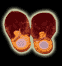 Blood-Soaked Moccasins